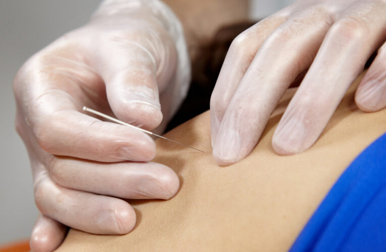 The Effective Treatment of Back Pain with Acupuncture in New York City 